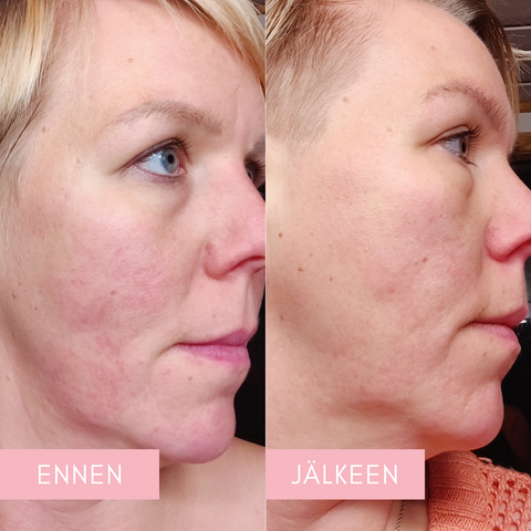 AHA & BHA Peeling Serum -yöseerumi ennen ja jälkeen kokemukset