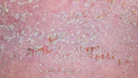 dermatitis seborreica