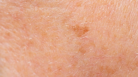 manchas oscuras en la piel