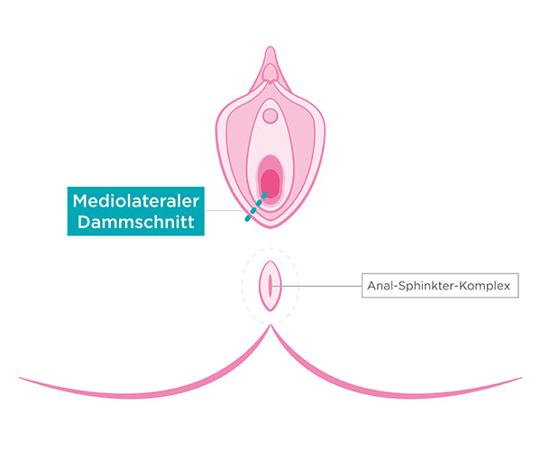 Mediolateraler Dammschnitt