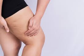 Cellulite e ritenzione