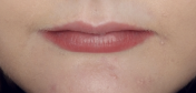 Natural Lips Before at home Lip Plumping