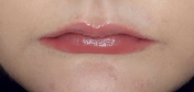 natural lips after topical lip plumper