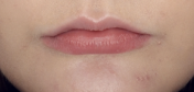 natural lips plumped after at home use of Droplette 17 Volt Lip Plumper