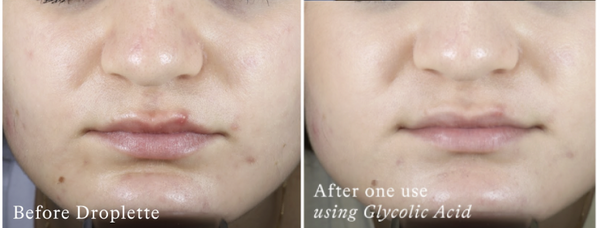 Droplette Before & Afters | Glycolic Serum Capsules 24 Hour Results