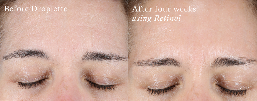 Droplette Retinol Serum Capsules Before and After Pictures