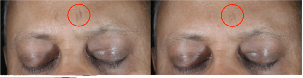 Droplette Collagen Serum Capsule Before and After Picture