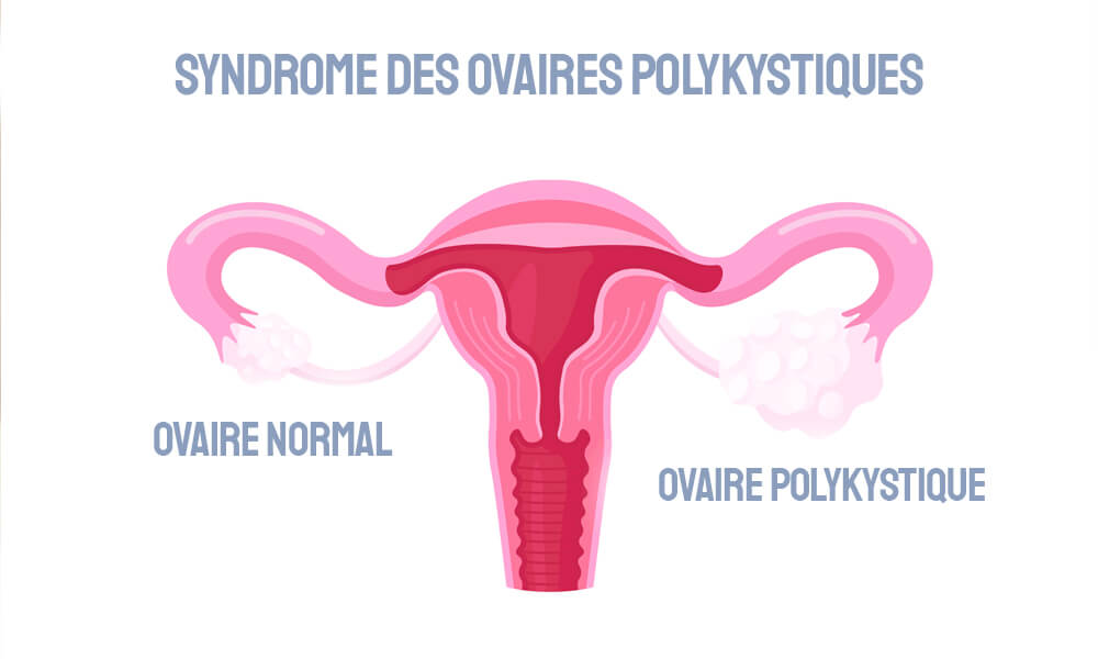 Syndrome des ovaires polykystiques (SOPK) - Soignants, témoignages