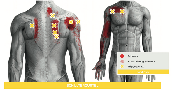 Triggerpunkte Schulter