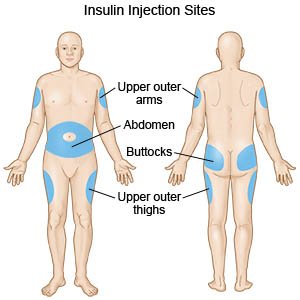 Insulin injection rotation sites
