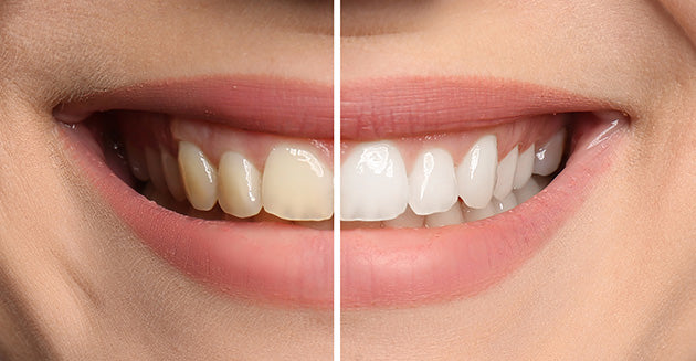 Woman's teeth before and after teeth whitening