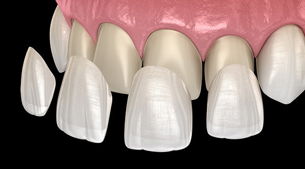 Cosmetic dental veneers illustration