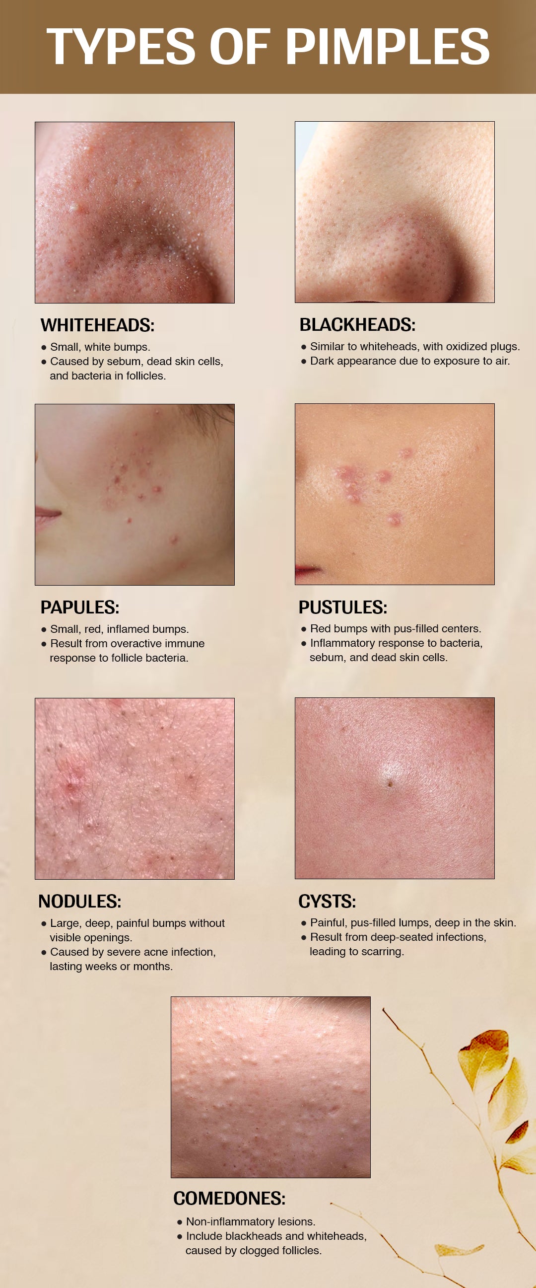 Types of Pimples