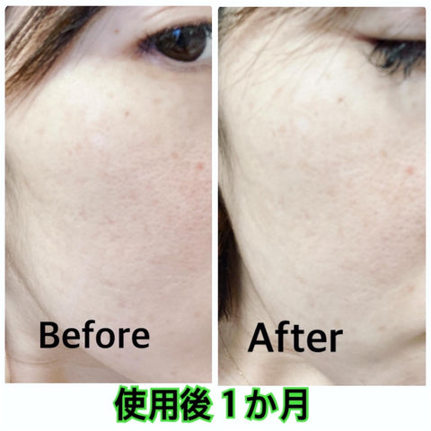 ROSE PLACENTA GEL BRIGHTENING １ヶ月使用した比較画像