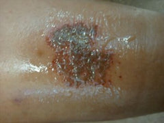 leg wound