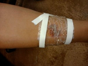 leg wound with salve