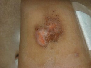 leg wound