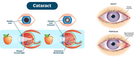 Cataract and diseases caused due to exposure to Ultraviolet radiation