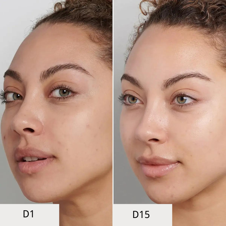 Bruadar Before and After reduce blemish
