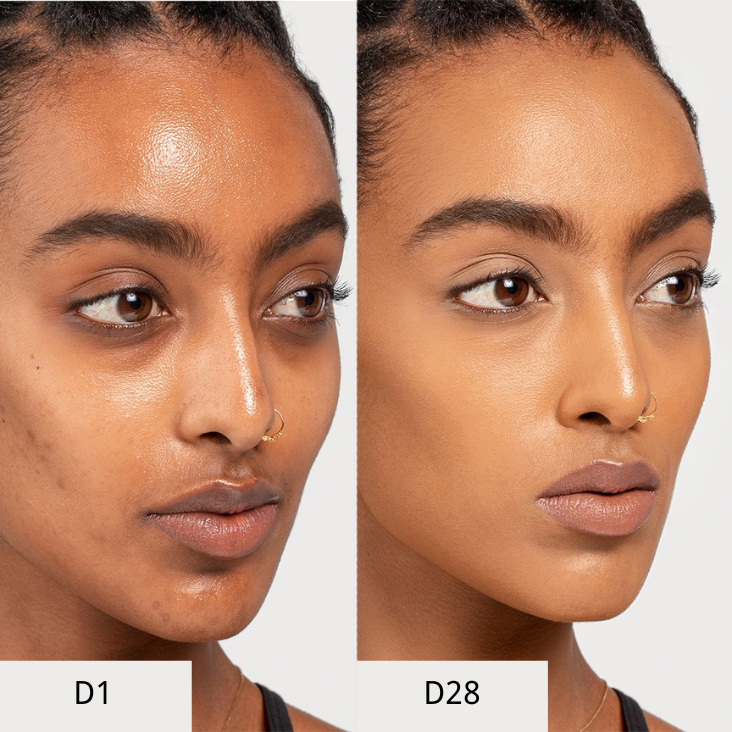 Bruadar Before and After Reduce Acne