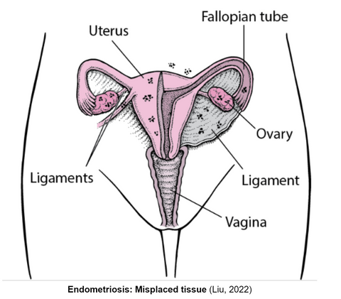 endometriosis is a complex, chronic disorder.