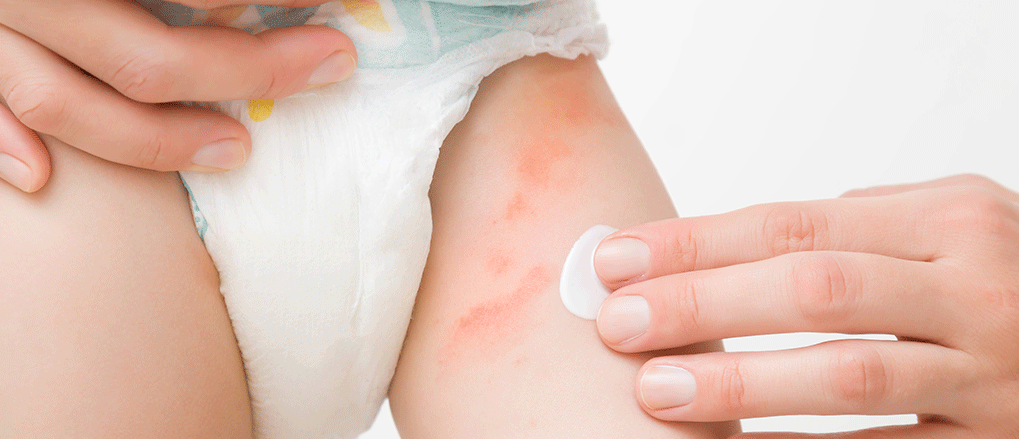 Diaper Rash Treatment