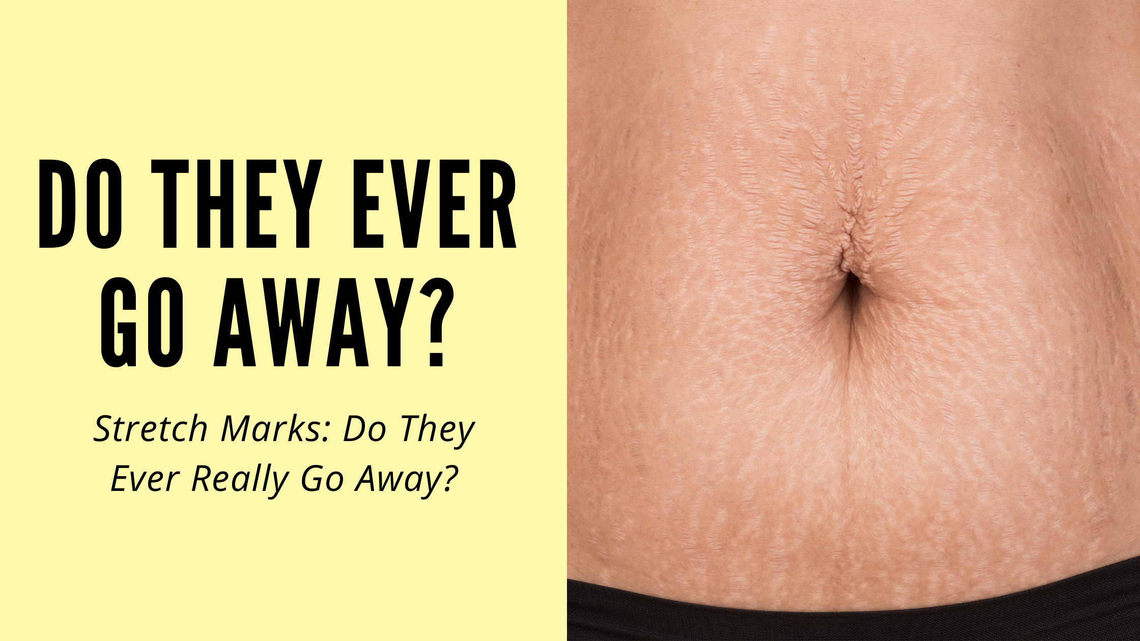 The Biggest Myths About Stretch Marks, Debunked by Experts