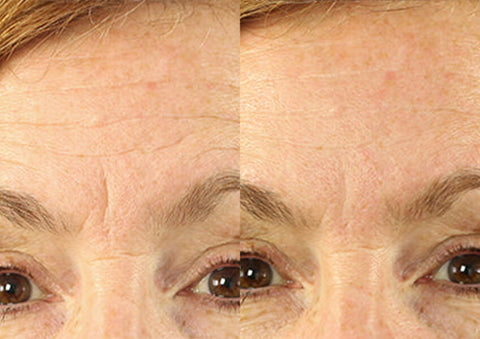 botox for forehead wrinkles