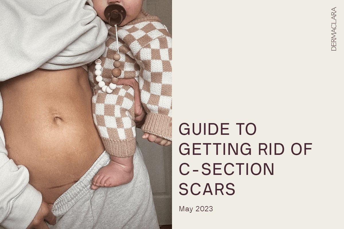 Say Goodbye to C-Section Scars: Comprehensive Removal Patch Guide