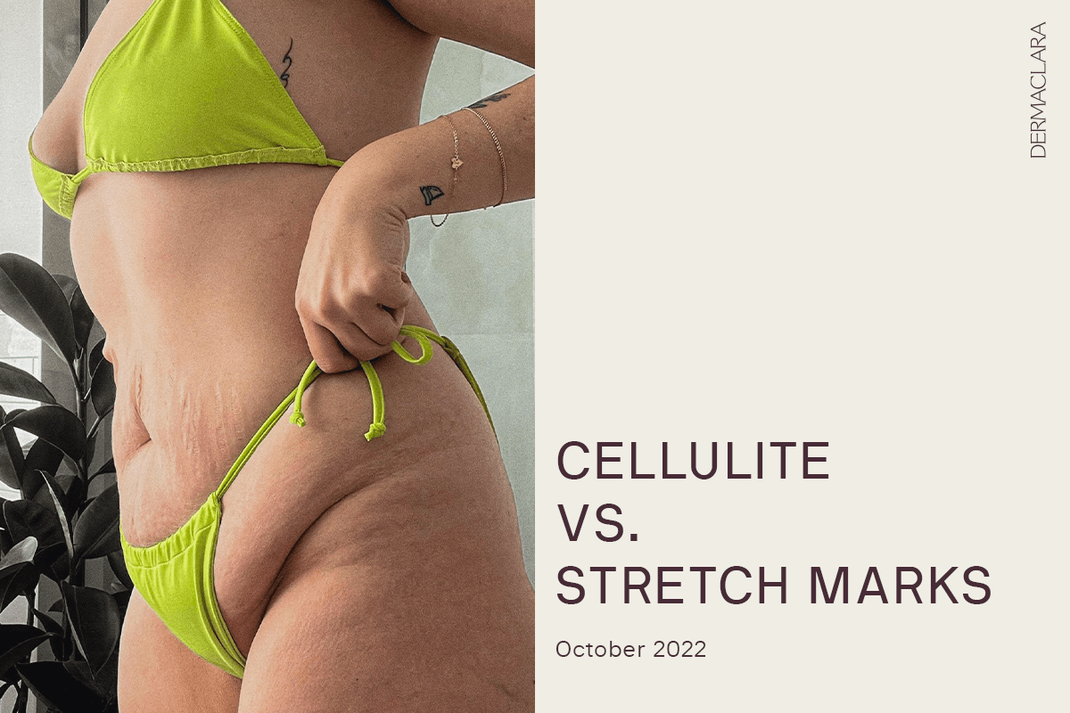 cellulite vs stretch mark