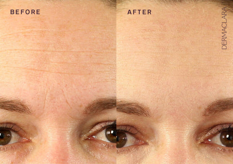 dermabrasion before and after