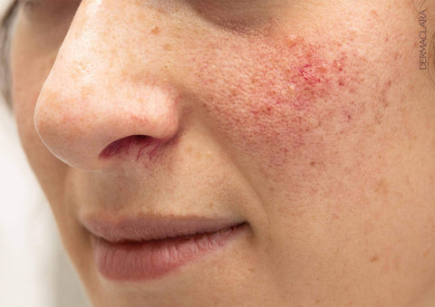 rosacea treatment