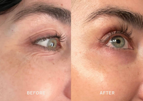 hyaluronic acid before and after