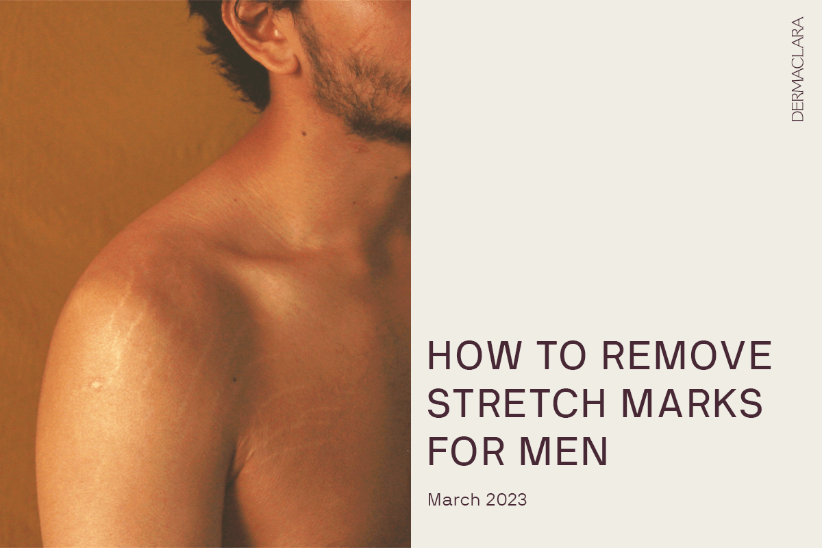 stretch marks men removal