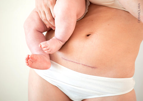 Say Goodbye to C-Section Scars: Comprehensive Removal Patch Guide