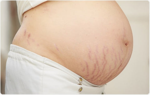 All The Colors Of Stretch Marks & How Treat Them