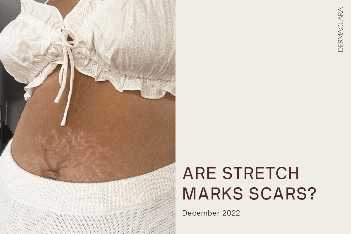 scars stretch marks