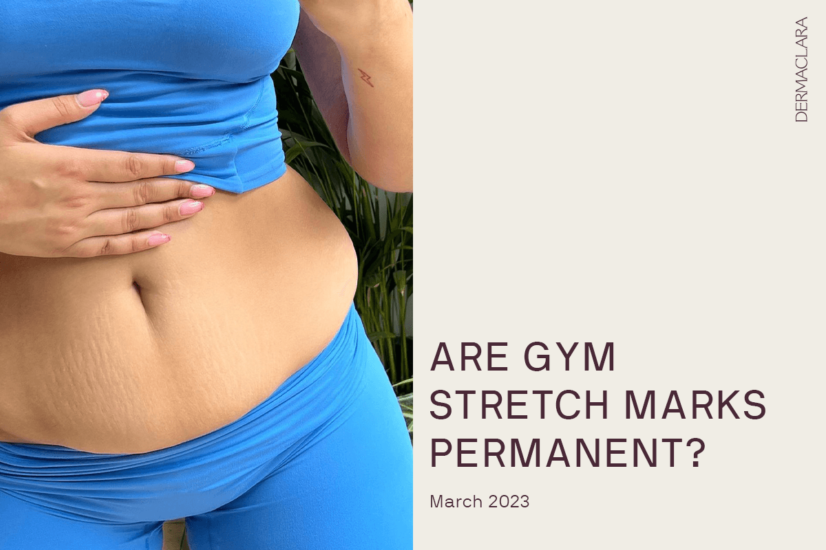 Say Goodbye to Doubts: Here's the Real Answers About Gym Stretch Marks