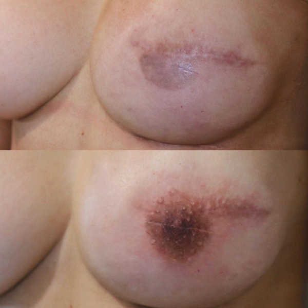 Areola Tattooing Gallery Image 9