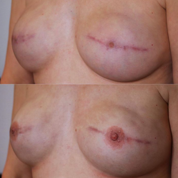 Areola Tattooing Gallery Image 1