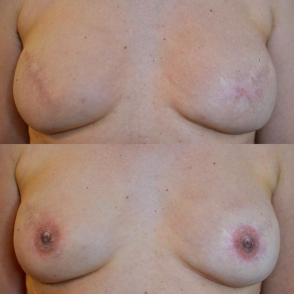 Areola Tattooing Gallery Image 10