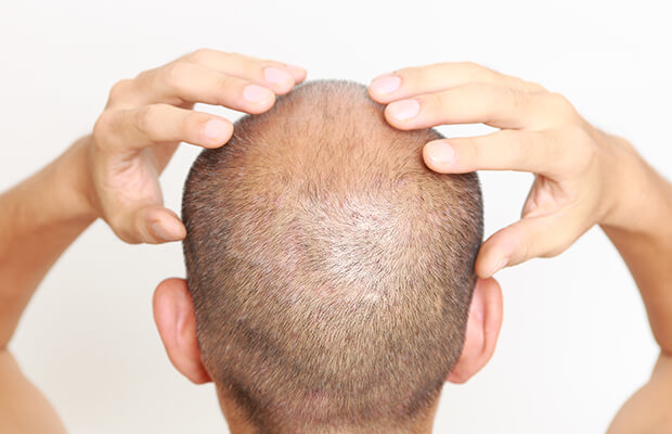 man goes bald after using Trenbolone