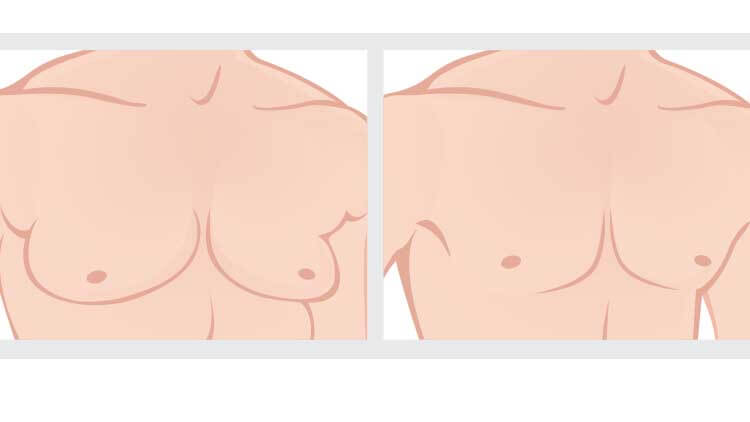 illustration of Gynecomastia