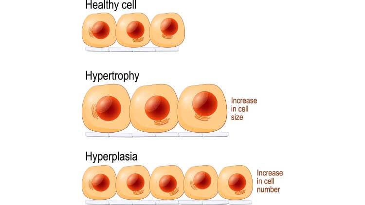 healthy cells, hypertrophy and hyperplasia