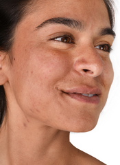 natural skin showing pigmentation from acne