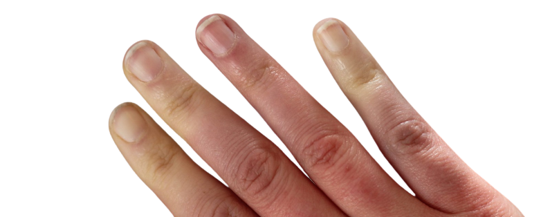 Causes Maladie de Raynaud