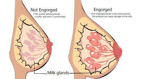 breast-engorgement