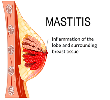 breast-mastitis