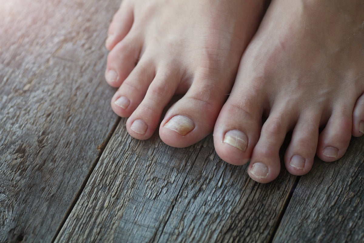 The REAL Cause of Toenail Fungus is ... - YouTube