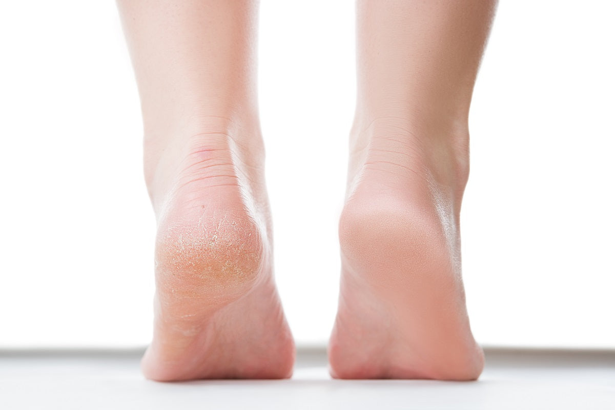 Treatment And Prevention For Cracked, Dry Heels (Heel Fissure) | Footfiles